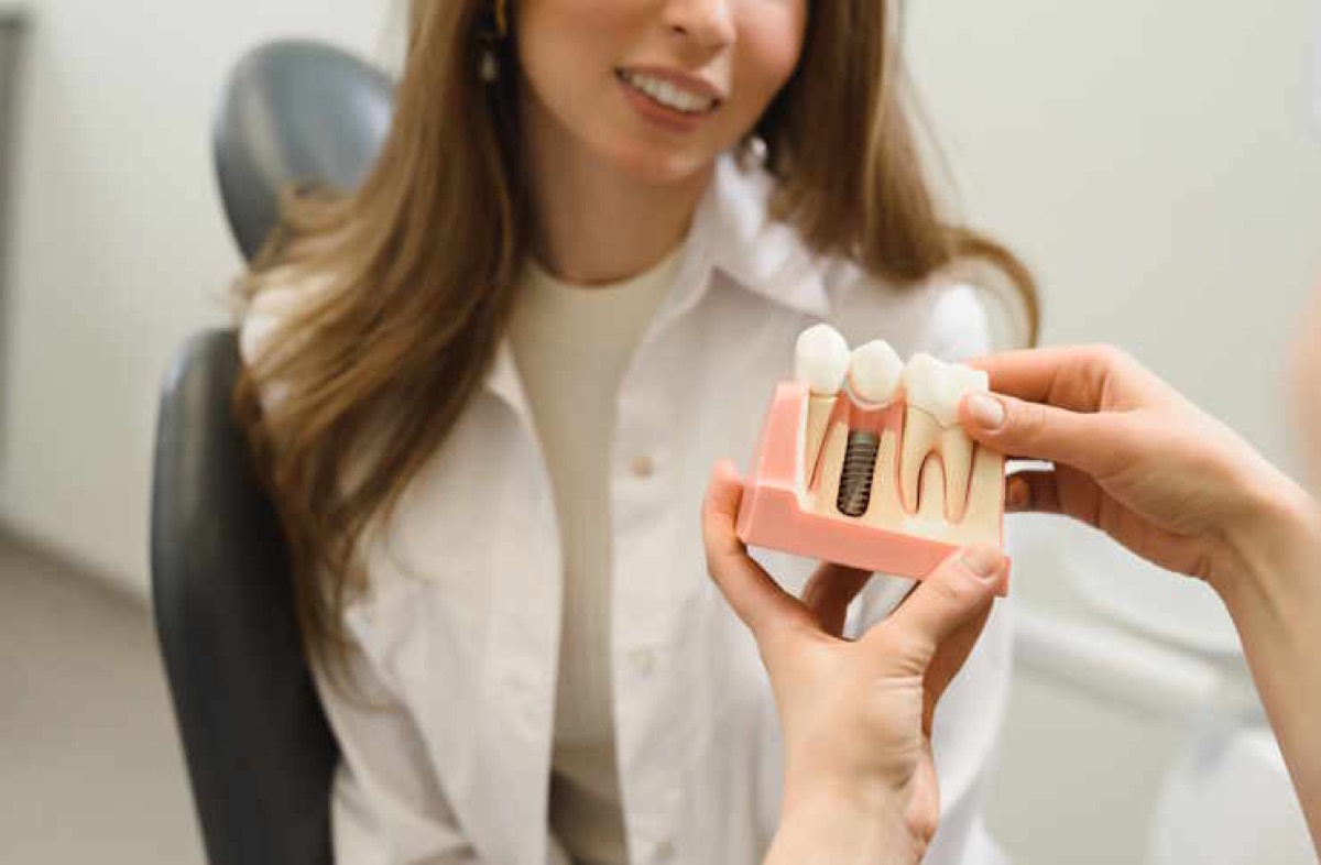 Screwless Implants Pricing guide